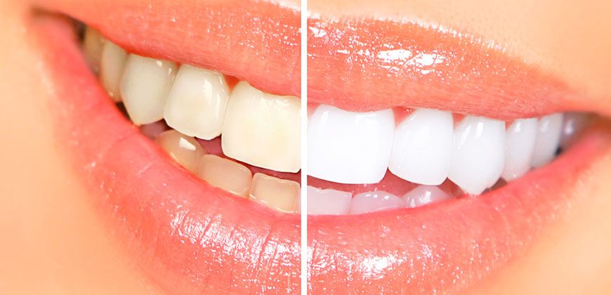 blanqueamiento dental laser pinto