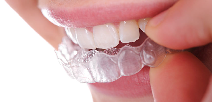 dentista invisalign pinto