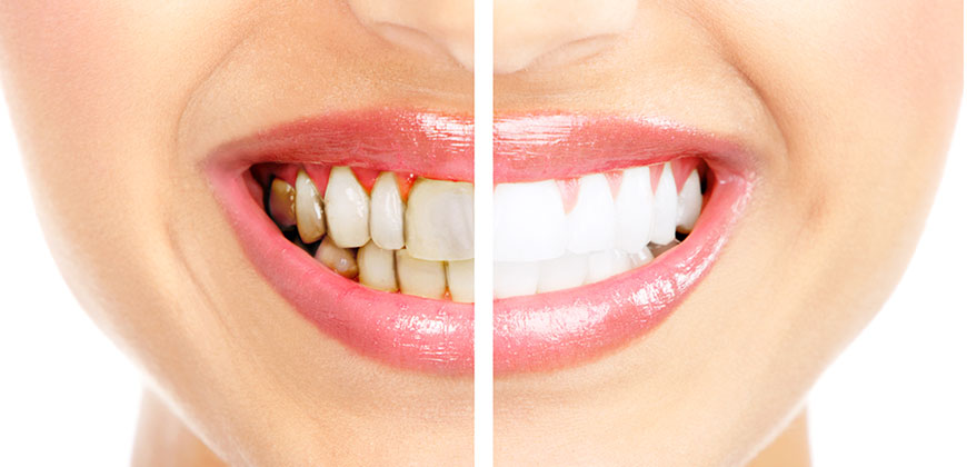 blanqueamiento dental laser pinto